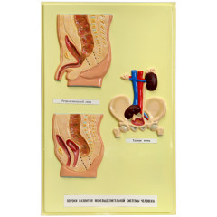 Модель рельефная Пороки развития мочевыделительной системы человека 1 планшет 420х660 мм