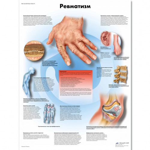 Плакат медицинский Ревматизм