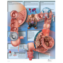 Плакат медицинский Рак толстой кишки
