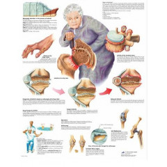 Плакат медицинский Артрит