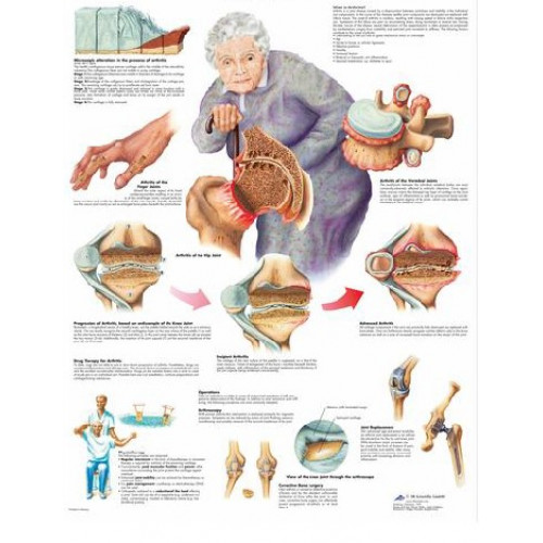 Плакат медицинский Артрит