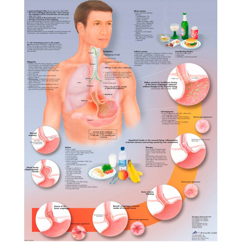 Плакат медицинский Желудочно-пищевой рефлюкс